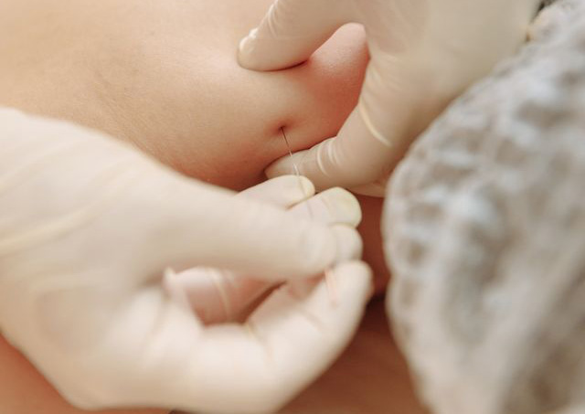 Procedimiento de inyección de mesoterapia